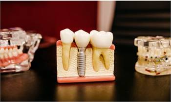 Why Are Dental Implants The Best Choice For Missing Teeth?